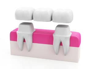 dentalbridgepink