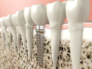 dentalimplantbonetissue