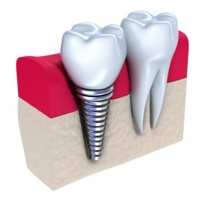 Concept Picture of a Crown Topped Dental Implant