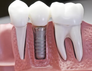 flynndentalimplants