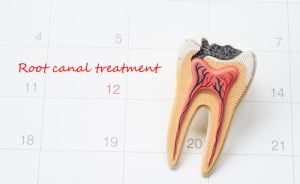 flynnrootcanal