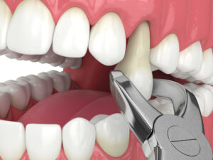 west allis tooth extraction