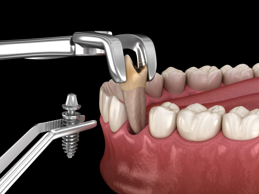 west allis tooth extraction