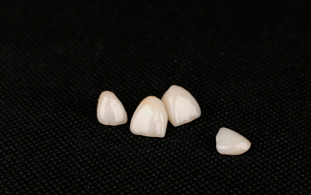 west allis porcelain veneers