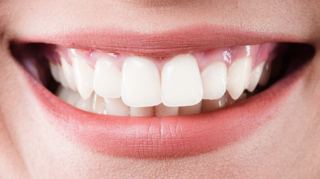 stubbs dental fillings