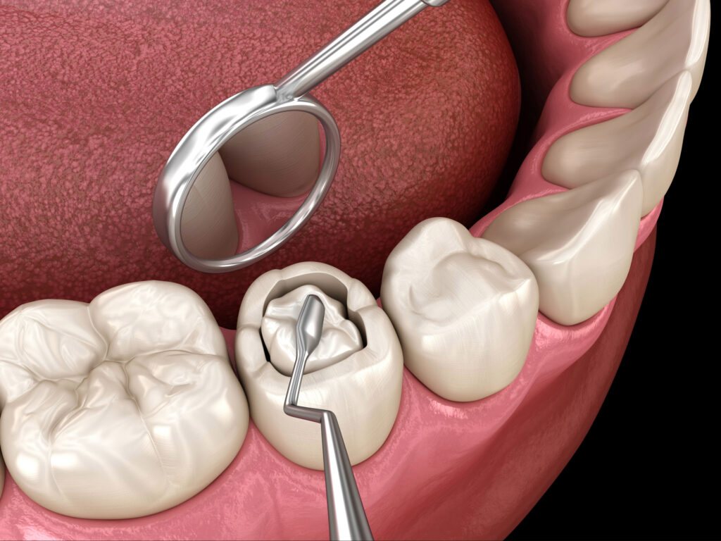west allis fillings